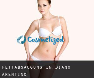 Fettabsaugung in Diano Arentino
