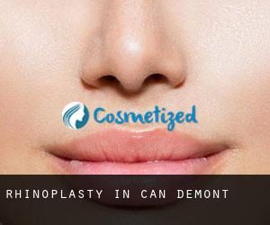 Rhinoplasty in Can Demont