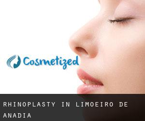 Rhinoplasty in Limoeiro de Anadia Rhinoplasty in Limoeiro de Anadia