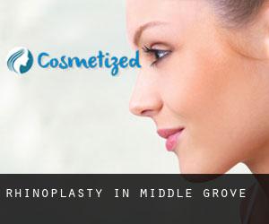 Rhinoplasty in Middle Grove