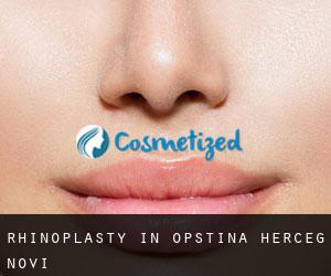 Rhinoplasty in Opština Herceg Novi Rhinoplasty in Opština Herceg Novi
