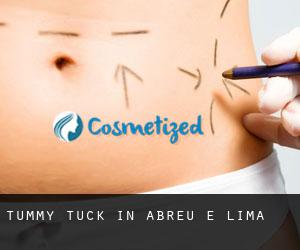 Tummy Tuck in Abreu e Lima