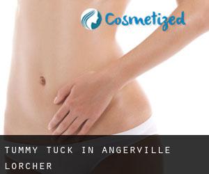 Tummy Tuck in Angerville-l'Orcher