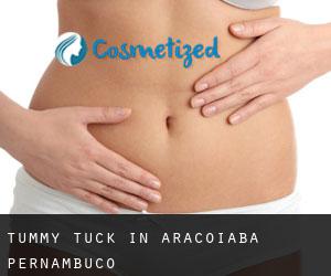 Tummy Tuck in Araçoiaba (Pernambuco)