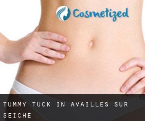Tummy Tuck in Availles-sur-Seiche