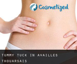 Tummy Tuck in Availles-Thouarsais