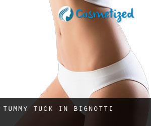 Tummy Tuck in Bignotti
