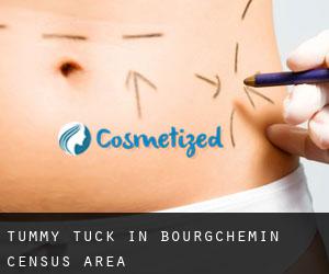 Tummy Tuck in Bourgchemin (census area)