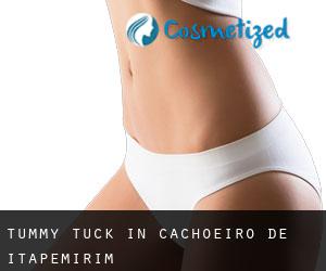 Tummy Tuck in Cachoeiro de Itapemirim