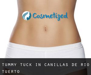 Tummy Tuck in Canillas de Río Tuerto