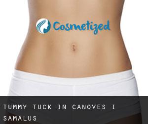 Tummy Tuck in Cànoves i Samalús