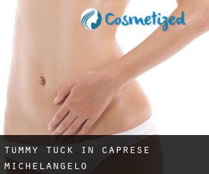 Tummy Tuck in Caprese Michelangelo