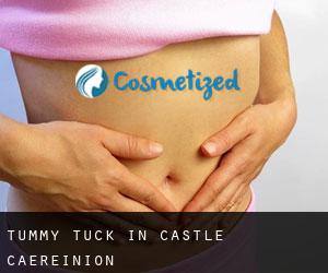 Tummy Tuck in Castle Caereinion