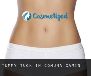 Tummy Tuck in Comuna Cãmin