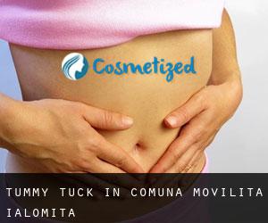 Tummy Tuck in Comuna Moviliţa (Ialomiţa)