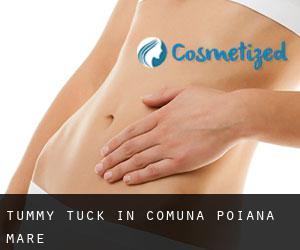Tummy Tuck in Comuna Poiana Mare
