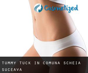 Tummy Tuck in Comuna Scheia (Suceava)