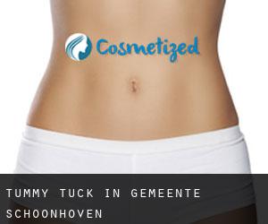 Tummy Tuck in Gemeente Schoonhoven
