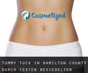 Tummy Tuck in Hamilton County durch testen besiedelten gebiet - Seite 6