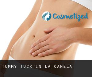Tummy Tuck in La Canela
