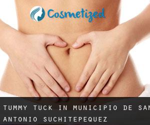 Tummy Tuck in Municipio de San Antonio Suchitepéquez