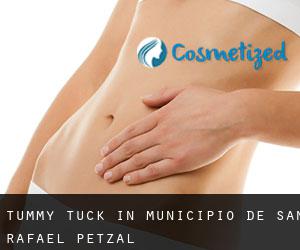 Tummy Tuck in Municipio de San Rafael Petzal