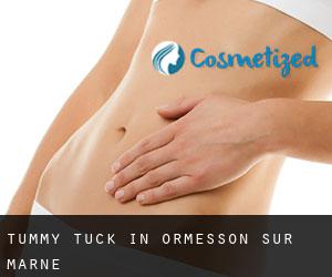 Tummy Tuck in Ormesson-sur-Marne