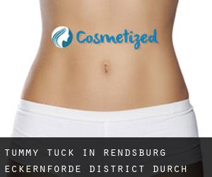 Tummy Tuck in Rendsburg-Eckernförde District durch hauptstadt - Seite 2