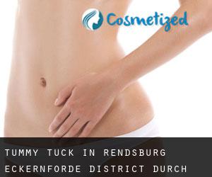 Tummy Tuck in Rendsburg-Eckernförde District durch stadt - Seite 1