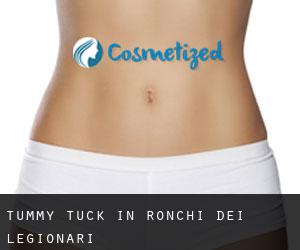 Tummy Tuck in Ronchi dei Legionari