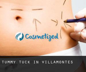 Tummy Tuck in Villamontes