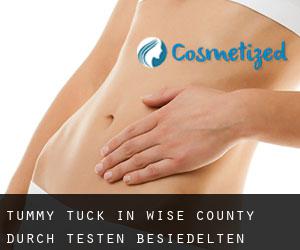 Tummy Tuck in Wise County durch testen besiedelten gebiet - Seite 1